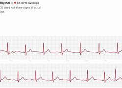 Image result for Inconclusive EKG Apple Watch