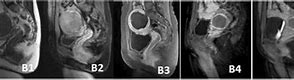 Image result for 8Cm Fibroid