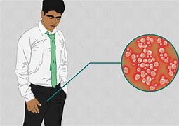 Image result for Male Genital Warts Symptoms