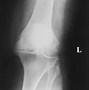 Image result for Osteoarthritis Arthritis Knee