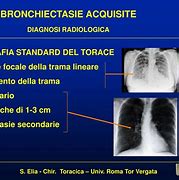 Image result for broncorrea