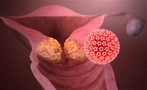 Image result for Cervical Cancer Mass