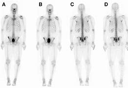 Image result for RSD Bone Scan