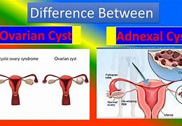 Image result for Torsion of Right Adnexal Cyst