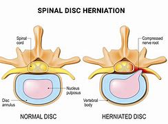 Image result for C4 to C5 Herniated Disc Symptoms