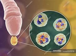 Image result for Gonorrhea Infection