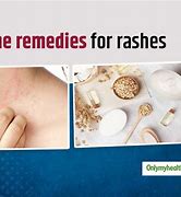 Image result for Skin Allergy Rash Home Remedies
