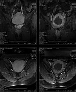 Image result for Clustered Fibroid Uterus