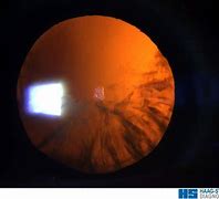Image result for Slit Lamp Retina
