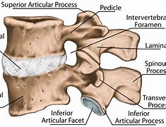 Image result for Lumbar Spine Transverse Process Fracture