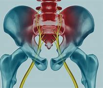 Image result for SI Joint Dysfunction Sciatica