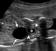 Image result for Fetal Ovarian Cyst Ultrasound