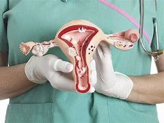 Image result for Cyst On Ovaries with Teeth and Hair