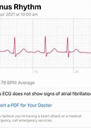 Image result for Abnormal Heart ECG Apple Watch