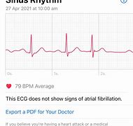 Image result for Normal ECG Apple Watch