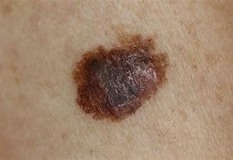 Image result for Skin Cancer Spots