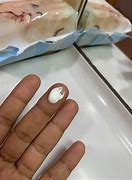 Image result for Pea Size Abrasion