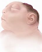 Image result for Anencephaly Diagram