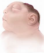 Image result for Severe Anencephaly