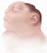 Image result for Anencephalic Infant