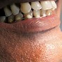 Image result for Flexilytes Partial Dentures
