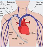 Image result for Central Venous Access Catheter