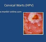 Image result for Warts On Cervix