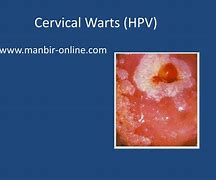 Image result for Warts On Cervix