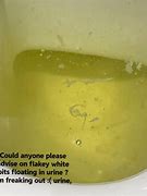 Image result for Kidney Stone Flakes in Urine