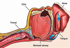Image result for Recovery Position Airway