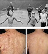 Image result for Burned by Napalm Girl