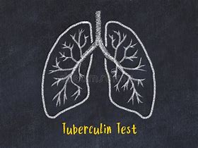 Image result for Bovine Single Intradermal Tuberculin Test