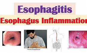 Image result for Esophageal Esophagitis