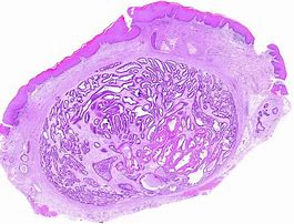Image result for Skin Color Benign Adnexal Tumor