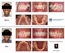 Image result for Protruding Jaw After Braces