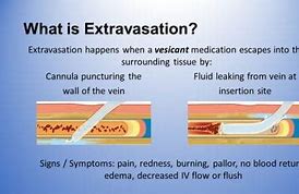 Image result for extravasarse