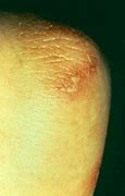 Image result for Gonorrhea Pustules