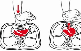 Image result for CPR Perfusing Heart and Brain