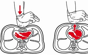 Image result for Heart and Stroke CPR Chest Compressions