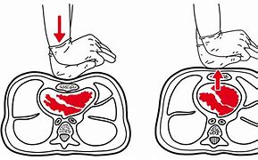 Image result for CPR Chest Compressions Adult