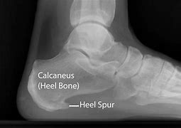 Image result for Corporal Bone Spurs