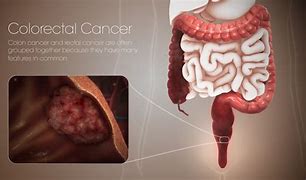 Image result for Anemia in Colorectal Cancer