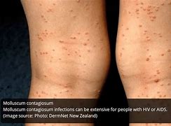 Image result for Sexually Transmitted Skin Diseases