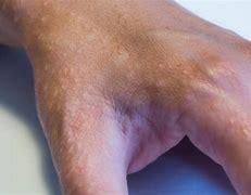 Image result for What Does Eczema Look Like