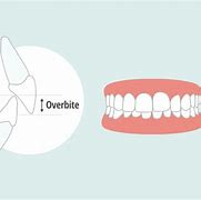 Image result for Tooth Overjet and Overbite