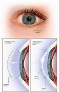 Image result for Corneal