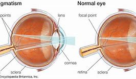 Image result for Astigmatism Real Eye