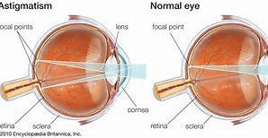 Image result for Astigmatism Eye IRL