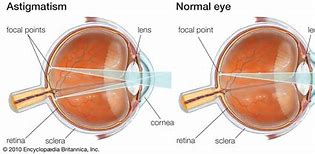 Image result for Astigmatism Eye Sight