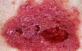 Image result for Basal Cell Nevus Syndrome